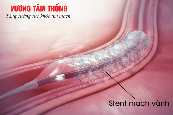 Stent mạch vành dùng trong xử trí nhồi máu cơ tim cấp.jpg